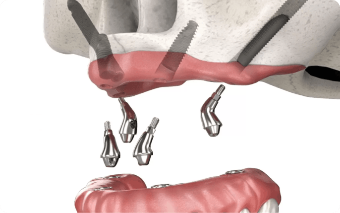 Zygoma Implant Visualization