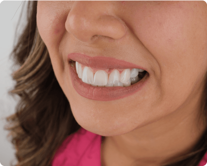 Dental Veneer Treatment